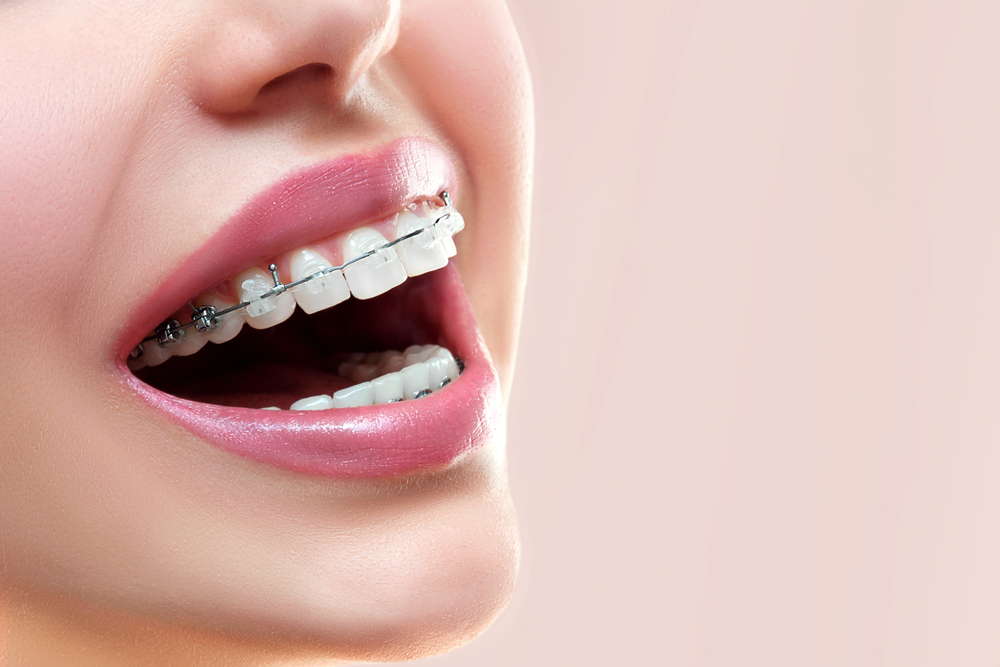 understanding dental braces types benefits and how they work