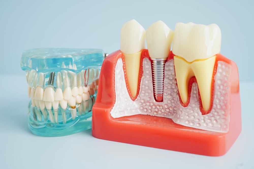 what are dental implants benefits process and costs explained